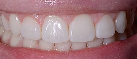 Лечение кариеса, художественная реставрация зубов, удлинение клинической коронки